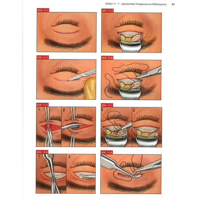 OKÜLOPLASTİ VE ORBİTA CERRAHİSİ ATLASI