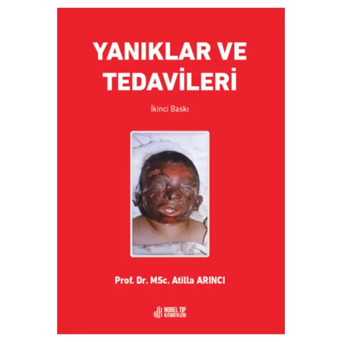 Yanıklar ve Tedavileri